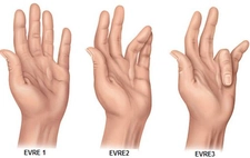 İltihaplı Eklem Romatizması Belirtileri ve Tedavisi